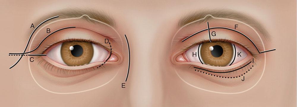 Orbital Surgery